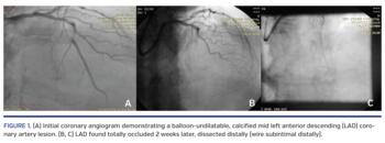 (A) Initial coronary angiogram demonstrating a balloon-undilatable, calcified mid left anterior descending (LAD) coronary artery lesion. (B, C) LAD found totally occluded 2 weeks later, dissected distally (wire subintimal distally).