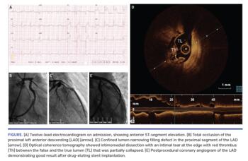 Twelve-lead electrocardiogram on admission, showing anterior ST-segment elevation. (B) Total occlusion of the proximal left anterior descending (LAD) (arrow). (C) Confined lumen narrowing filling defect in the proximal segment of the LAD (arrow). (D) Optical coherence tomography showed intimomedial dissection with an intimal tear at the edge with red thrombus (Th) between the false and the true lumen (TL) that was partially collapsed. (E) Postprocedural coronary angiogram of the LAD demonstrating good resul