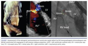 Assessment of the iatrogenic perimembranous ventricular septal defect by (A) transesophageal echocardiogram and (B) left ventricular (LV) angiogram in left anterior oblique projection. LVOT = left ventricular outflow tract; VS = ventricular septum; TV = tricuspid valve; MV = mitral valve; RV = right ventricle; mAV = mechanical aortic valve.