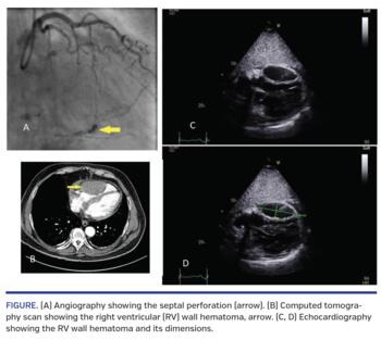 Angiography showing the septal perforation (arrow). (B) Computed tomography scan showing the right ventricular (RV) wall hematoma, arrow. (C, D) Echocardiography showing the RV wall hematoma and its dimensions.