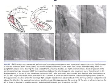 The high-velocity systolic jet (red cone) preceding wire advancement into the left ventricular cavity (LVC) through a critically stenosed aortic valve (CSAV).