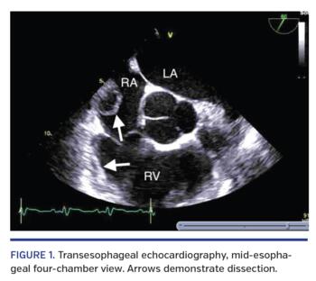Transesophageal echocardiography, mid-esophageal four-chamber view. Arrows demonstrate dissection.