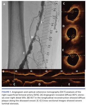 Angiogram and optical coherence tomography (OCT) analysis of the right superficial femoral artery (SFA). (A) Angiogram revealed diffuse 80% stenosis over right distal SFA. (B) OCT in the longitudinal reconstruction showed diffuse plaque along the diseased vessel. (C-E) Cross-sectional images showed severe luminal stenosis.