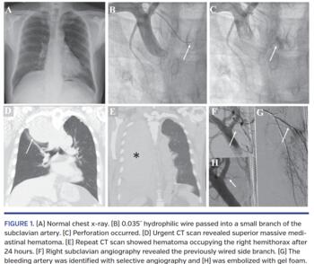 A) Normal chest x-ray. (B) 0.035˝ hydrophilic wire passed into a small branch of the subclavian artery. (C) Perforation occurred. (D) Urgent CT scan revealed superior massive mediastinal hematoma. (E) Repeat CT scan showed hematoma occupying the right hemithorax after 24 hours. (F) Right subclavian angiography revealed the previously wired side branch. (G) The bleeding artery was identified with selective angiography and (H) was embolized with gel foam.
