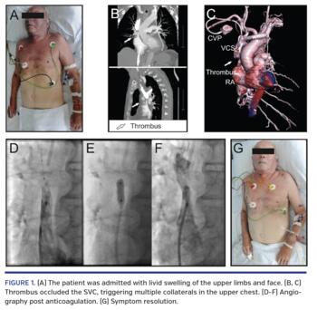 (A) The patient was admitted with livid swelling of the upper limbs and face. (B, C) Thrombus occluded the SVC, triggering multiple collaterals in the upper chest. (D-F) Angiography post anticoagulation. (G) Symptom resolution.