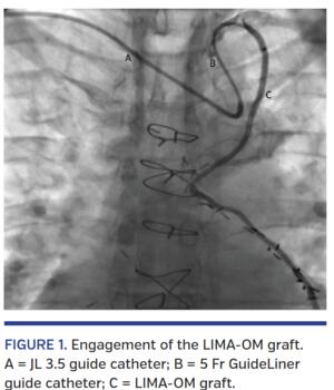 Engagement of the LIMA-OM graft. A = JL 3.5 guide catheter; B = 5 Fr GuideLiner guide catheter; C = LIMA-OM graft.