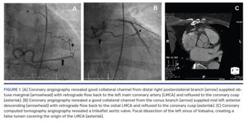 (A) Coronary angiography revealed good collateral channel from distal right posterolateral branch (arrow) supplied obtuse marginal (arrowhead) with retrograde flow back to the left main coronary artery (LMCA) and refluxed to the coronary cusp (asterisk). (B) Coronary angiography revealed a good collateral channel from the conus branch (arrow) supplied mid left anterior descending (arrowhead) with retrograde flow back to the ostial LMCA and refluxed to the coronary cusp (asterisk). (C) Coronary computed tomo