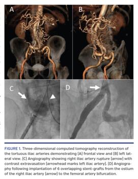 Three-dimensional computed tomography reconstruction of the tortuous iliac arteries demonstrating (A) frontal view and (B) left lateral view. (C) Angiography showing right iliac artery rupture (arrow) with contrast extravasation (arrowhead marks left iliac artery). (D) Angiography following implantation of 6 overlapping stent-grafts from the ostium of the right iliac artery (arrow) to the femoral artery bifurcation.