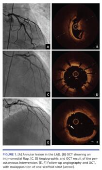 (A) Annular lesion in the LAD. (B) OCT showing an intimomedial flap. (C, D) Angiographic and OCT result of the percutaneous intervention. (E, F) Follow-up angiography and OCT, with malapposition of one scaffold strut (arrow).