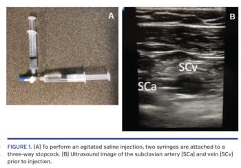 (A) To perform an agitated saline injection, two syringes are attached to a three-way stopcock. (B) Ultrasound image of the subclavian artery (SCa) and vein (SCv) prior to injection.