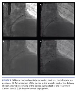 Detached and partially expanded device in the left atrial appendage. 