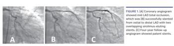 (A) Coronary angiogram showed mid LAD total occlusion, which was (B) successfully stented from ostial to distal LAD with two overlapping sirolimus-eluting stents. (C) Four-year follow-up angiogram showed patent stents.
