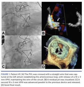 Patient #1. (A) The PVL was crossed with a straight wire that was captured at the left atrium establishing the arteriovenous loop, with release of a 10 x 3 mm VPIII, maintaining the wire of the circuit. (B) A residual jet was visualized. (C) A second 10 x 3 mm VPIII was advanced parallel to the previous device and released. (D) Good final result.