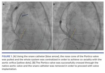 (A) Using the snare catheter (blue arrow), the nose cone of the Portico valve was pulled and the whole system was centralized in order to achieve co-axiality with the aortic orifice (yellow dots). (B) The Portico valve was successfully crossed through the native aortic valve and the snare catheter was removed in order to proceed with valve implantation.