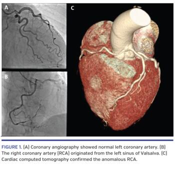 (A) Coronary angiography showed normal left coronary artery. (B) The right coronary artery (RCA) originated from the left sinus of