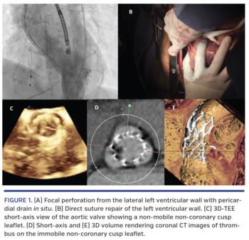 (A) Focal perforation from the lateral left ventricular wall with pericardial drain in situ. (B) Direct suture repair of the left ventricular wall. (C) 3D-TEE short-axis view of the aortic valve showing a non-mobile non-coronary cusp leaflet. (D) Short-axis and (E) 3D volume rendering coronal CT images of thrombus on the immobile non-coronary cusp leaflet.