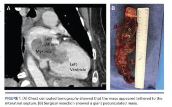 (A) Chest computed tomography showed that the mass appeared tethered to the interatrial septum. (B) Surgical resection showed a giant pedunculated mass.