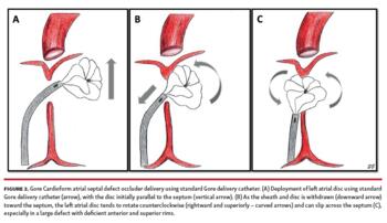 Figure 2. Gore Cardioform atrial septal defect occluder delivery