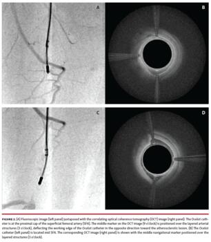 Fluoroscopic image (left panel) juxtaposed with the correlating optical coherence tomography