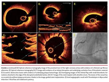 Optical coherence tomography image of the proximal tract of the right coronary artery