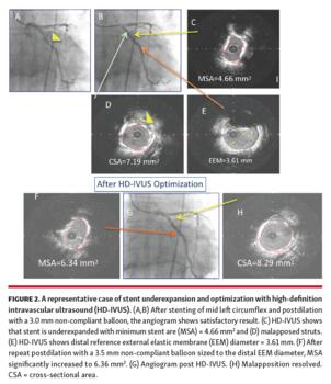 A representative case of stent underexpansion and optimization with high-definition intravascular ultrasound (HD-IVUS).