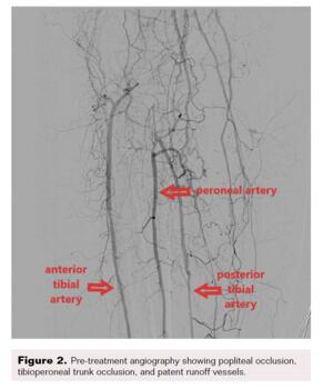 Fig 2. Pretreatment angiography