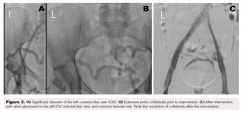Fig 2. Stenosis and intervention