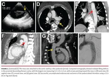 Figure 1. (continued) (C) The mass was attached to the aortic wall by a thin peduncle (arrow). Computed tomography showed multiple filling defects in the proximal descending thoracic aorta, with the largest one measuring 1.2 x 1.4 x 1.2 cm, with arrows pointing toward the mass in (D) axial view; (E) sagittal view; (F) coronal view; and (G) gated view. (H) Successful, uncomplicated endovascular exclusion of the pedunculated thrombus using a 3.1 x 10 cm Tag stent (Gore).