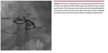 Figure 2. Still frame of angiogram done through pericardial sheath (brown arrow) in the tributary of the middle cardiac vein (MCV) reveals contrast opacification of the coronary sinus body as well as draining through the coronary sinus ostium (CS Os) into the right atrium (blue arrow). The spillage of contrast can be seen into the pericardium overlying the right atrium.