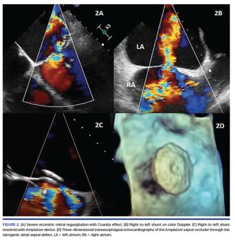 Severe eccentric mitral regurgitation with Coanda effect. (B) Right-to-left shunt on color Doppler.