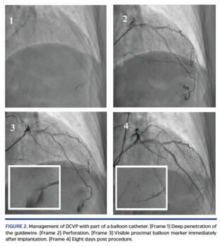 Management of DCVP with part of a balloon catheter.