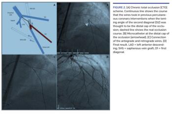 Chronic total occlusion (CTO) scheme. Continuous line shows the course that the wires took in previous percutaneous coronary interventions when the tenting angle of the second diagonal (D2) was thought to be the distal cap of the occlusion; dashed line shows the real occlusion course.