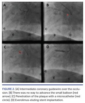 Intermediate coronary guidewire over the occlusion. (B) There was no way to advance the small balloon (red arrow). (C) Penetration of the plaque with a microcatheter (red circle). (D) Everolimus-eluting stent implantation
