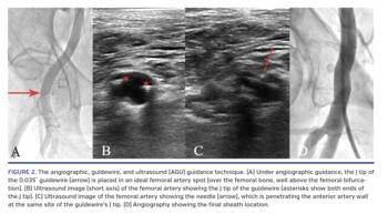 The angiographic, guidewire, and ultrasound (AGU) guidance technique. (A) Under angiographic guidance, the J tip of the 0.035˝ guidewire (arrow) is placed in an ideal femoral artery spot (over the femoral bone, well above the femoral bifurcation). (B) Ultrasound image (short axis) of the femoral artery showing the J tip of the guidewire (asterisks show both ends of the J tip). (C) Ultrasound image of the femoral artery showing the needle (arrow), which is penetrating the anterior artery wall at the same sit