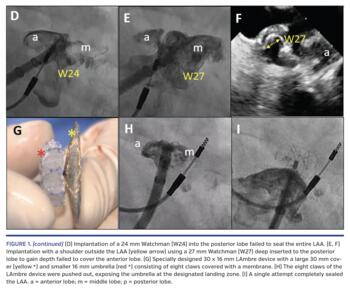 (continued) (D) Implantation of a 24 mm Watchman (W24) into the posterior lobe failed to seal the entire LAA. (E, F) Implantation with a shoulder outside the LAA (yellow arrow) using a 27 mm Watchman (W27) deep inserted to the posterior lobe to gain depth failed to cover the anterior lobe. (G) Specially designed 30 x 16 mm LAmbre device with a large 30 mm cover (yellow *) and smaller 16 mm umbrella (red *) consisting of eight claws covered with a membrane. (H) The eight claws of the LAmbre device were pushe