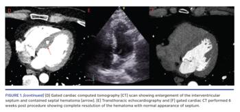 (continued) (D) Gated cardiac computed tomography (CT) scan showing enlargement of the interventricular septum and contained septal hematoma (arrow). (E) Transthoracic echocardiography and (F) gated cardiac CT performed 6 weeks post procedure showing complete resolution of the hematoma with normal appearance of septum.