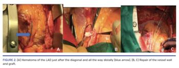 (A) Hematoma of the LAD just after the diagonal and all the way distally (blue arrow). (B, C) Repair of the vessel wall and graft.
