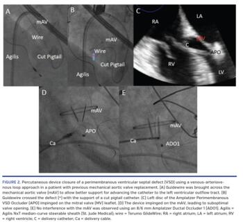Percutaneous device closure of a perimembranous ventricular septal defect (VSD) using a venous-arteriovenous loop approach in a patient with previous mechanical aortic valve replacement.