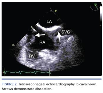 Transesophageal echocardiography, bicaval view. Arrows demonstrate dissection.