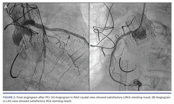 Final angiogram after PCI.