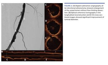 (A) Digital subtraction angiography after directional atherectomy showed enlargement of the vessel lumen without flow-limiting dissection. (B) Optical coherence tomography in the longitudinal reconstruction and (C-E) cross-sectional images showed significant improvement of luminal diameter.