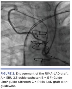 Engagement of the RIMA-LAD graft. A = EBU 3.5 guide catheter; B = 5 Fr Guide- Liner guide catheter; C = RIMA-LAD graft with guidewire.