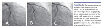 (A) Coronary angiogram showed total occlusion of the ostial LAD at 11-year follow-up. (B) Following balloon angioplasty, there was residual stenosis of the ostial LAD, suggestive of in-stent restenosis. (C) Final angiogram following PCI optimization showed good flow across the LAD without any residual stenosis.