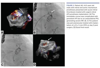 Patient #2. A 61-year-old male with mitral and aortic mechanical prostheses presented with acute mitral thrombosis treated with urgent mitral ATS prosthesis implantation. (A) The immediate course was complicated with persistent HF due to an anterolateral PVL generating severe MR. (B, C) The patient was percutaneously treated with implantation of a 12 x 5 mm VPIII on day 5 post surgery. (D) Good final result.