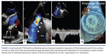 FIGURE 1. (continued) (E) TTVR with two MitraClip devices (arrows) resulted in reduction of TR jet (asterisk) and (F, G) a continuous left-to-right shunt flow (arrowheads) through iatrogenic ASD, followed by (H) implantation of an Amplatzer septal occluder (arrow), due to estimated shunt flow volume of 34.8 mL and Qp/Qs by 1.6. RA = right atrium; LA = left atrium.