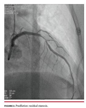 Predilation: residual stenosis.