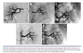 (A) Right renal artery without lesions and or filling faults, with adequate nephrographic effect. (B, C) Left renal artery with filling failure and high intraluminal thrombotic load, with decrease nephrographic effect. (D, E) Left renal artery after local intra-arterial thrombolysis, with no filling failure and improvement of the nephrographic effect.