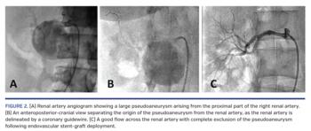 (A) Renal artery angiogram showing a large pseudoaneurysm arising from the proximal part of the right renal artery. (B) An anteroposterior-cranial view separating the origin of the pseudoaneurysm from the renal artery, as the renal artery is delineated by a coronary guidewire. (C) A good flow across the renal artery with complete exclusion of the pseudoaneurysm following endovascular stent-graft deployment.
