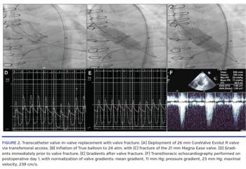Transcatheter valve-in-valve replacement with valve fracture