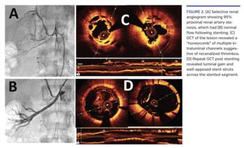 (A) Selective renal angiogram showing 95% proximal renal artery stenosis, which had (B) normal flow following stenting. (C) OCT of the lesion revealed a “honeycomb” of multiple intraluminal channels suggestive of recanalized thrombus. (D) Repeat OCT post stenting revealed luminal gain and well-apposed stent struts across the stented segment.